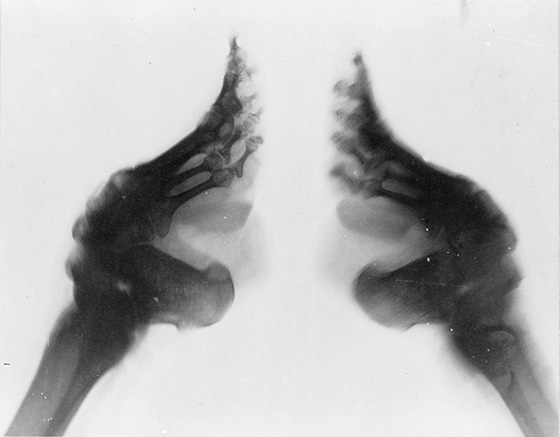 Radiografia di due piedi fasciati: arco plantare spaccato e il tallone molto vicino alla punta